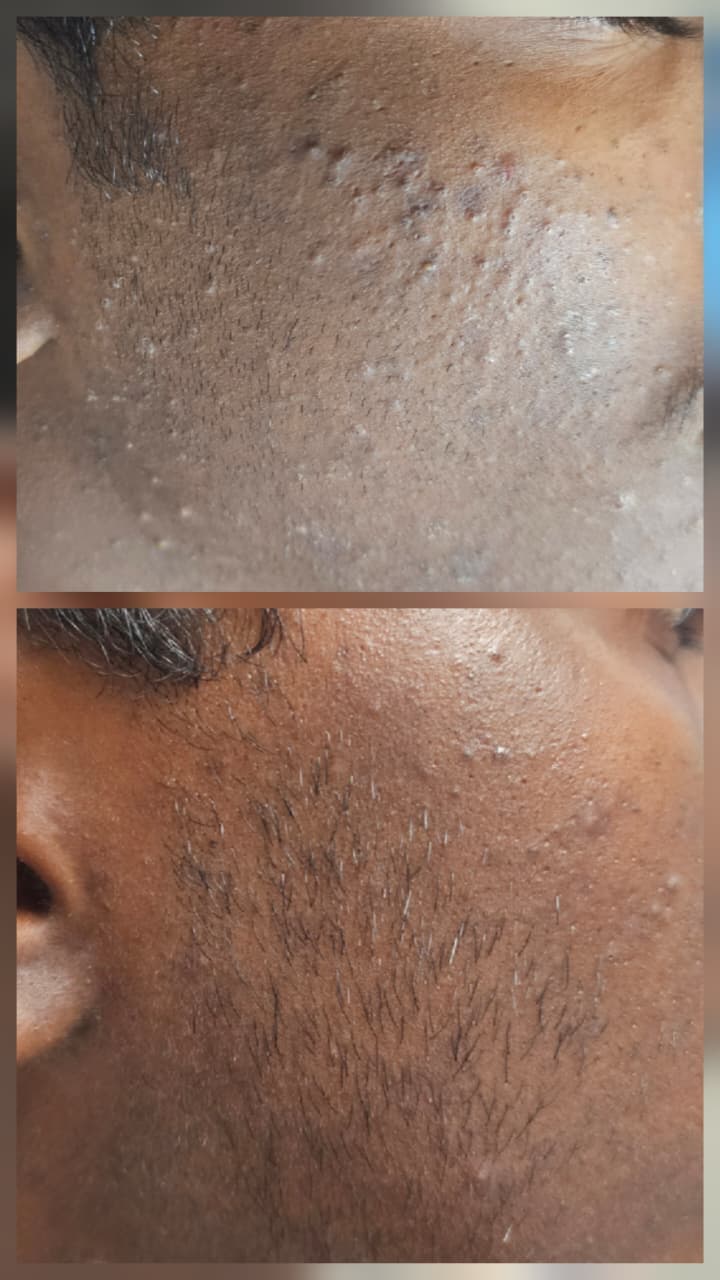 Active Acne Treatment Result