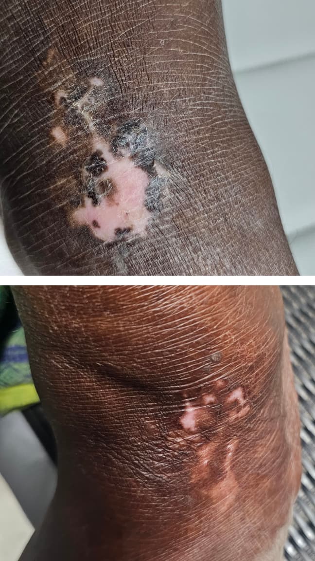 Vitiligo Treatment Result